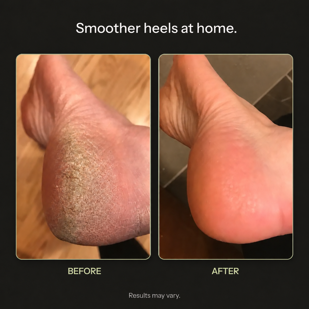 VIREVA — Before and after foot care